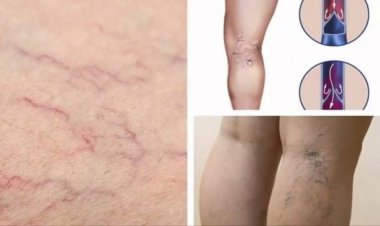 Bài thuốc trị viêm tắc động mạch chi