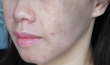 Những bài thuốc Nam đắp trị tàn nhang cực hiệu quả