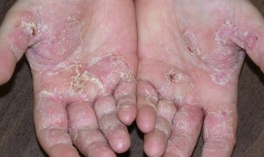 Những câu hỏi hay: Bệnh nứt da tróc vảy chữa thế nào?