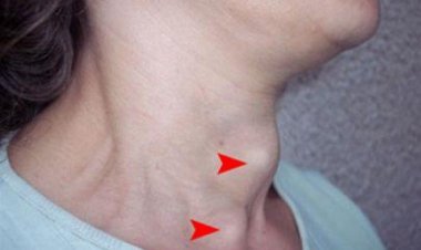 Bệnh Bướu cổ là gì