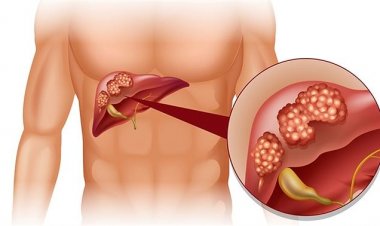 Bài thuốc quý hiếm: Các bài thuốc nam hỗ trợ, chữa bệnh ung thư gan, ung thư phổ và ung thư dạ dày