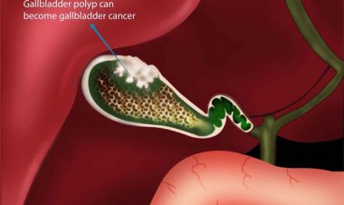 Bệnh túi mật: Những thói quen đặc biệt gây hại cho túi mật mà bạn nên tránh