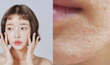 Bí quyết trị da mặt khô bong tróc tại nhà cho làn da đẹp mịn màng