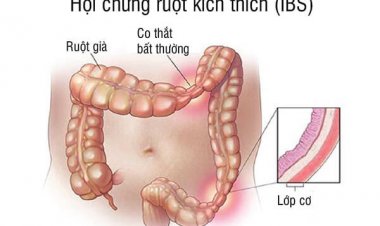 Bài Viết Chuyên Môn: Hội chứng ruột kích thích (IBS)