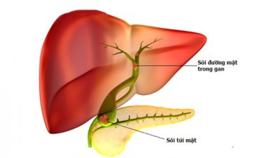 Bệnh thường gặp: Bệnh sỏi đường mật trong gan