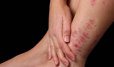 Bệnh ngoài da: Chữa mẩn ngứa ngoài da từ cây lá