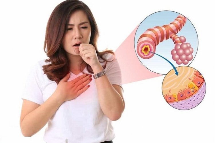 Bệnh viêm phế quản: Bài thuốc trị viêm phế quản