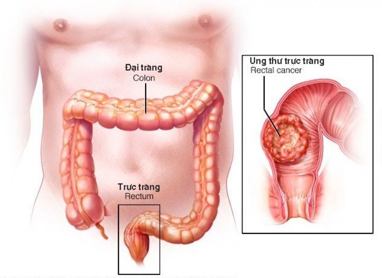 Bệnh ung thư đại tràng: Những người có nguy cơ mắc ung thư đại tràng cao