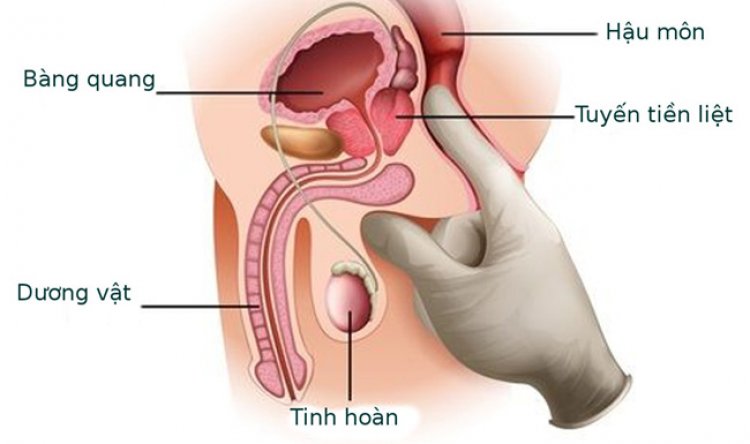 Bệnh ung thư : Ung thư tuyến tiền liệt không còn đáng sợ