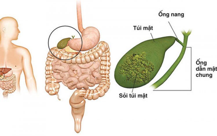 Bệnh túi mật: Polyp túi mật có thể trở thành ung thư không?