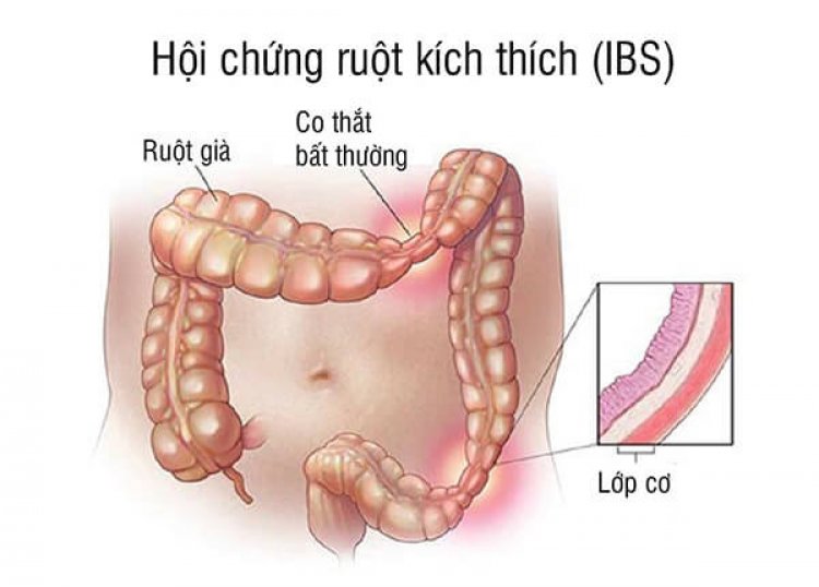 Bài Viết Chuyên Môn: Hội chứng ruột kích thích (IBS)