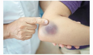 10 nguyên nhân làm bầm tím da