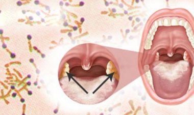 Dấu hiệu cảnh báo bạn mắc bệnh bạch hầu