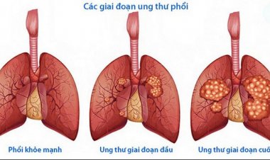 Ung thư phổi khó chữa khỏi nếu đến viện muộn