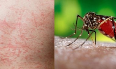 Các cấp độ của sốt xuất huyết và dấu hiệu đi kèm