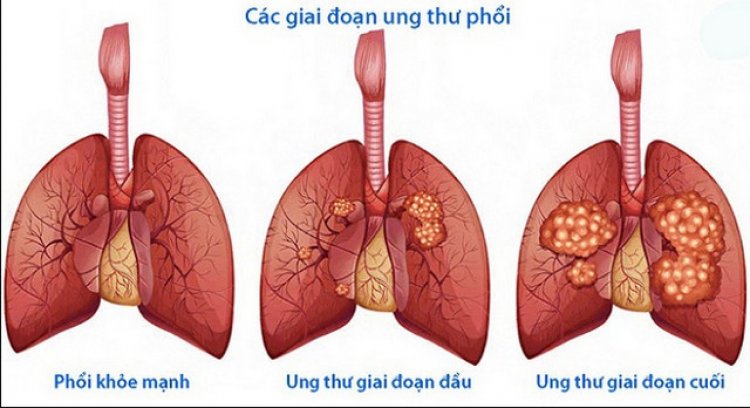 Ung thư phổi khó chữa khỏi nếu đến viện muộn