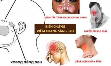 Thất bại trong xử lý viêm xoang, đi tìm lời giải hiệu quả
