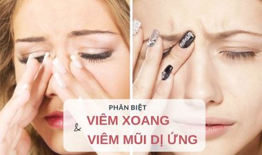 Phân biệt viêm xoang và viêm mũi dị ứng