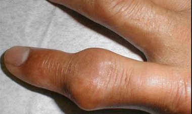 Bệnh gút phòng và chữa bệnh gút bằng đông y