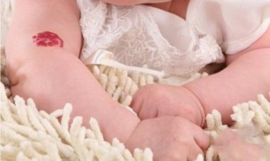 Bệnh u máu có nguy hiểm không?