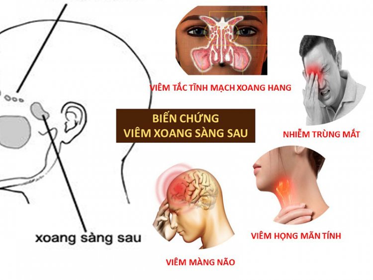 Thất bại trong xử lý viêm xoang, đi tìm lời giải hiệu quả