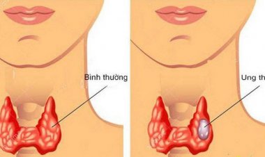 Chữa u tuyến giáp không cần mổ