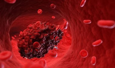 4 loại thực phẩm tự nhiên giúp làm loãng máu, ngăn ngừa cục máu đông gây đột quỵ