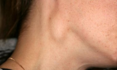 Hạch bạch huyết: Khi nào nổi hạch là dấu hiệu của bệnh ung thư?