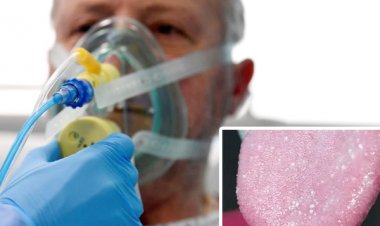 'Covid lưỡi', triệu chứng mới của đại dịch