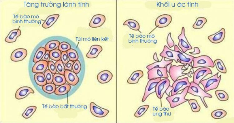 Phân biệt u lành tính và ác tính