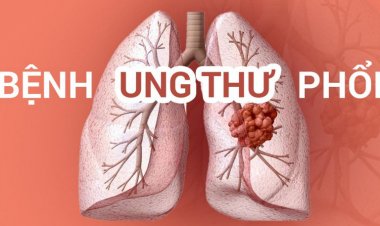 Phát hiện sớm và điều trị ung thư phổi như thế nào?