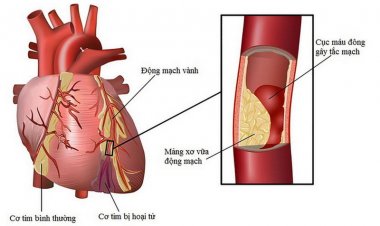 Dấu hiệu nhận biết bệnh tim mạch