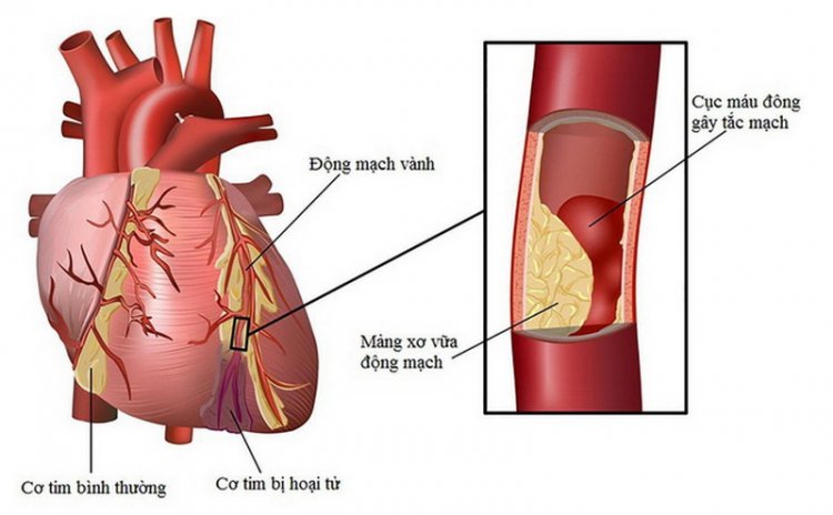 Dấu hiệu nhận biết bệnh tim mạch