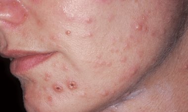 Bệnh thủy đậu ở người lớn nguy hiểm như thế nào?