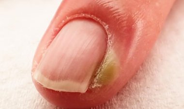 Chín mé gây biến chứng gì?