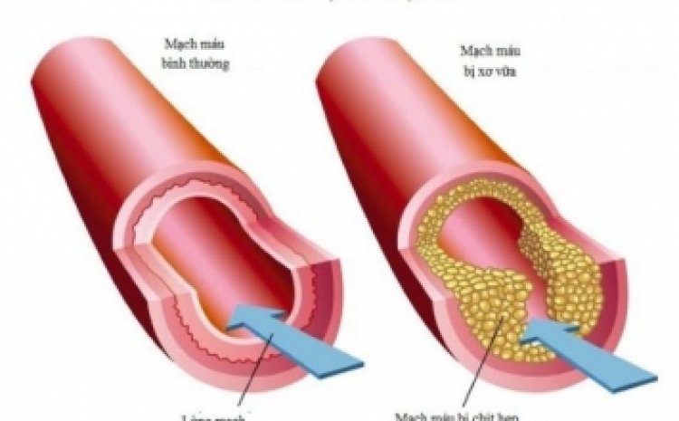 Sáng kiến toàn cầu mới về ung thư vú: Cải thiện khả năng sống sót cho người bệnh