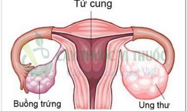 Ung thư buồng trứng căn bệnh cực kỳ nguy hiểm cho chị em phụ nữ