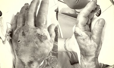 Nhiễm trùng, hoại tử bàn tay vì tự điều trị đái tháo đường tại nhà