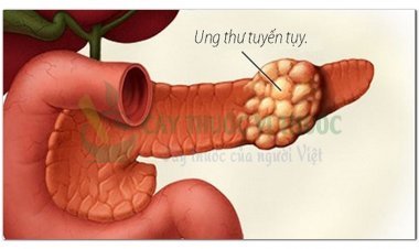 Hỏi đáp bệnh Ung thư: Các yếu tố làm tăng nguy cơ ung thư tụy