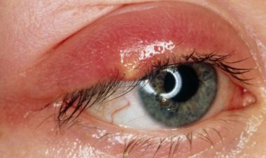 Bài thuốc hay chữa viêm bờ mi