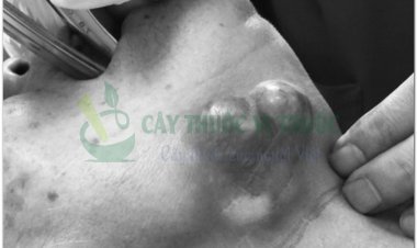 Những dấu hiệu để nhận biết bệnh ung thư tuyến nước bọt giai đoạn đầu của bệnh nếu có cần đi viện ngay