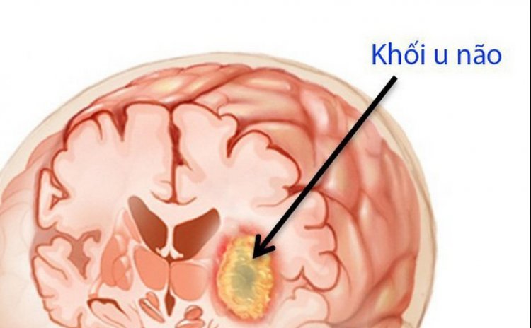 Phương pháp mới ngăn chặn sự lây lan của tế bào ung thư não