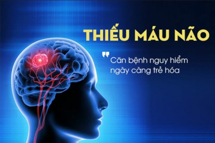 Thiếu máu não: Nguyên nhân gây thiếu máu não