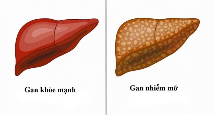 Cần làm gì khi bị gan nhiễm mỡ?