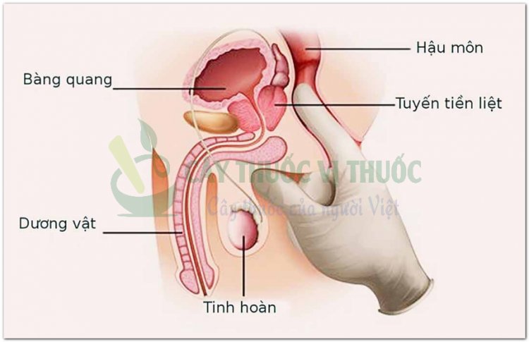 Hỏi đáp bệnh Ung Thư: Phương pháp điều trị ung thư tiền liệt tuyến bằng nội tiết