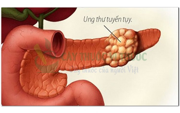 Hỏi đáp bệnh Ung thư: Các yếu tố làm tăng nguy cơ ung thư tụy