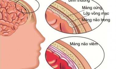 Viêm màng não mủ ở trẻ - Bệnh nguy hiểm nhưng có thể phòng ngừa