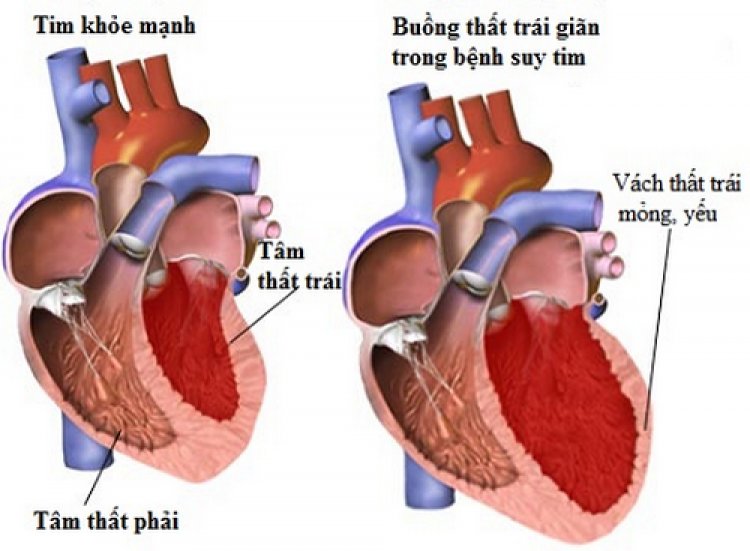 U trong tim, bệnh khó phòng ngừa