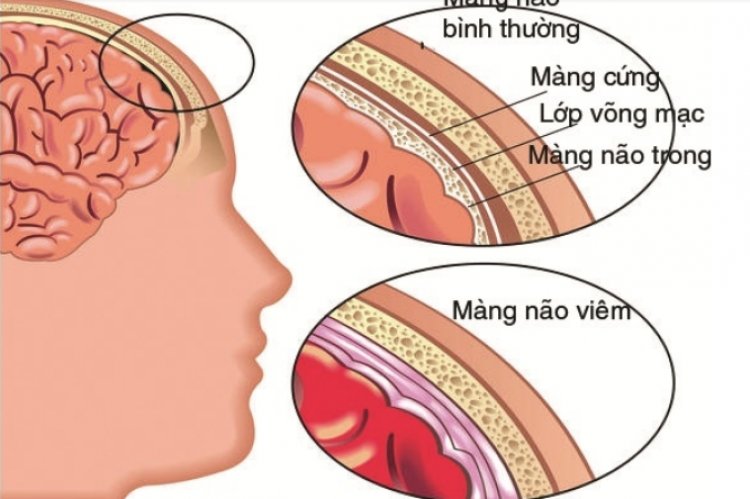 Viêm màng não mủ ở trẻ - Bệnh nguy hiểm nhưng có thể phòng ngừa