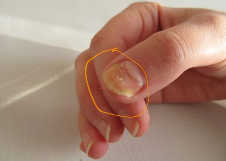 Nhận biết sớm mắc bệnh tiểu đường qua nhìn móng tay